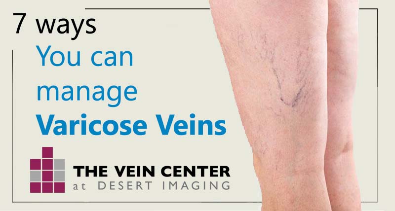 7 Ways You Can Manage Varicose Veins