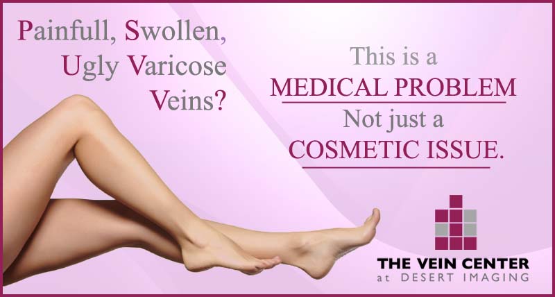 Varicose veins are not just a cosmetic issue