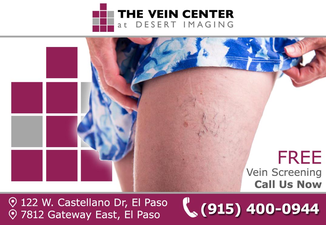 THE CAUSE OF SPIDER VEINS