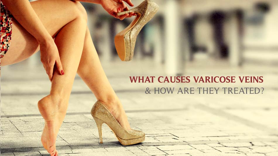 WHAT CAUSES VARICOSE VEINS & HOW ARE THEY TREATED?